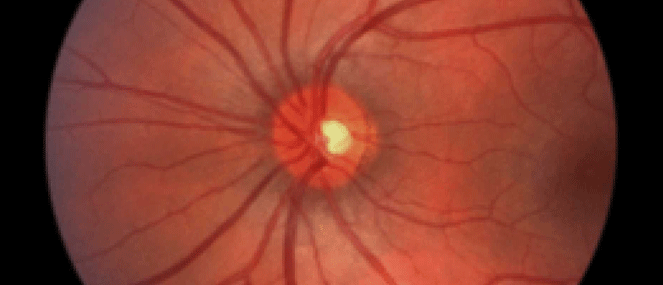 Macular disease condition factsheet
