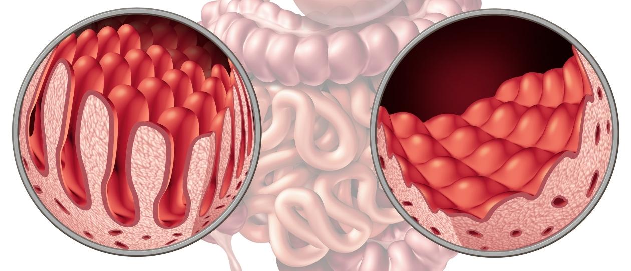 coeliac disease