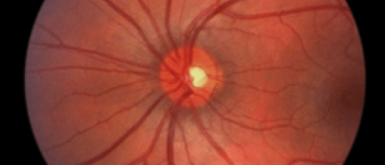 Macular-disease-Blackmores-Institut