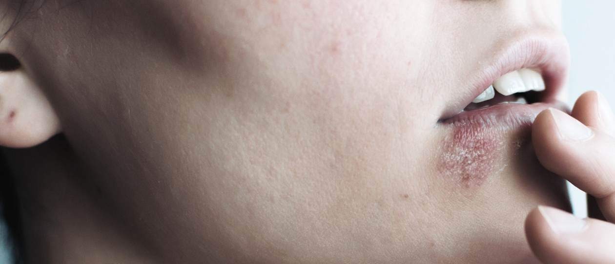 Lysine for Cold Sore Control
