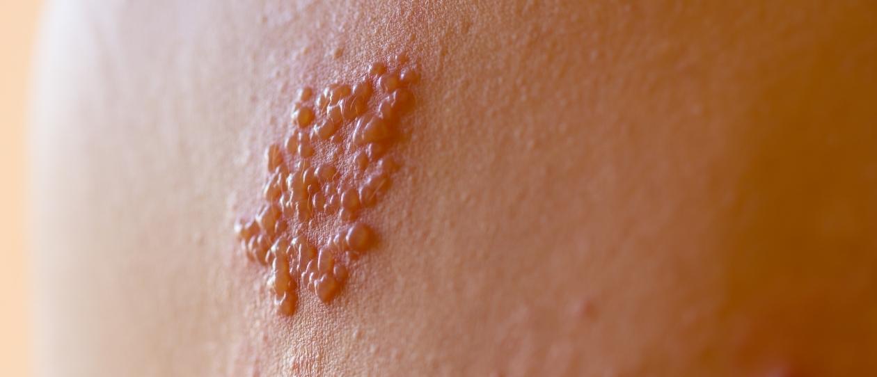 Shingles prevalence has been on the increase over the last few decades